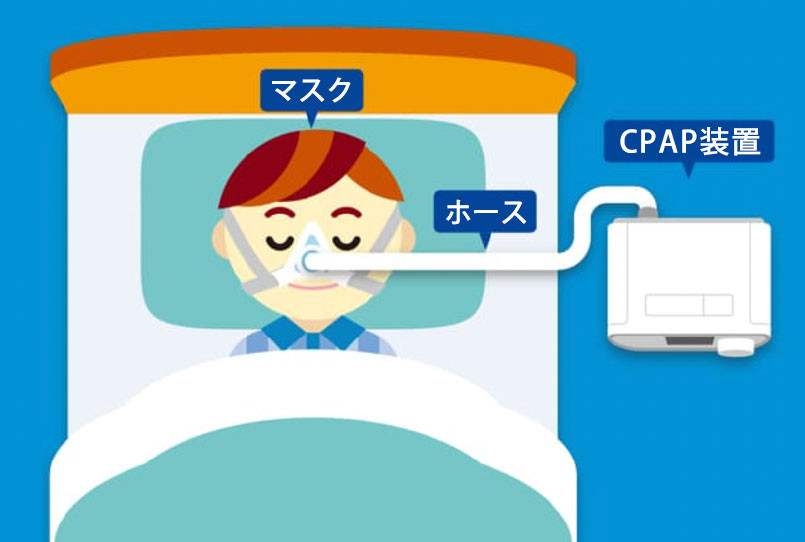 CPAP治療